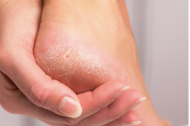 Hongos en los pies: Síntomas, tratamiento y prevención